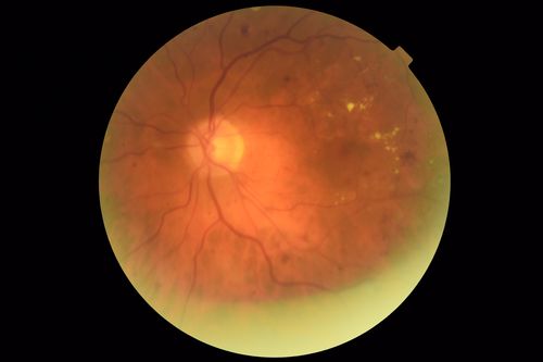 Diabetic Macular Edema with Exudates
Patient did not want injection therapy and did well with laser

