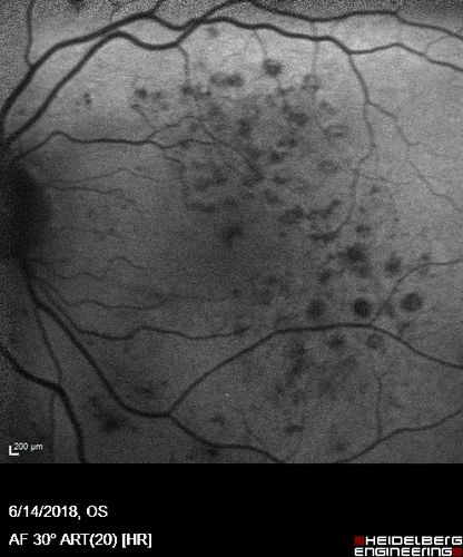 Diabetic Macular Edema with Exudates
Patient did not want injection therapy and did well with laser
