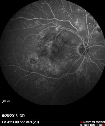 Diabetic Macular Edema with Exudates
Patient did not want injection therapy and did well with laser
