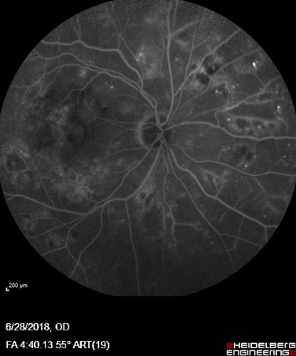 Diabetic Macular Edema with Exudates
Patient did not want injection therapy and did well with laser
