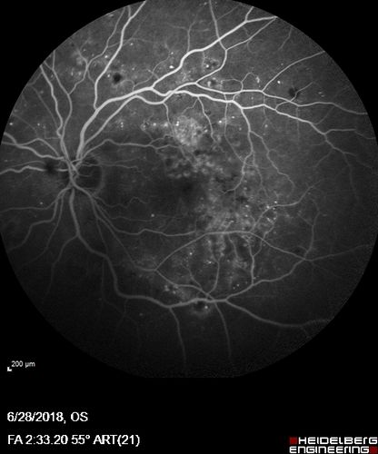 Diabetic Macular Edema with Exudates
Patient did not want injection therapy and did well with laser
