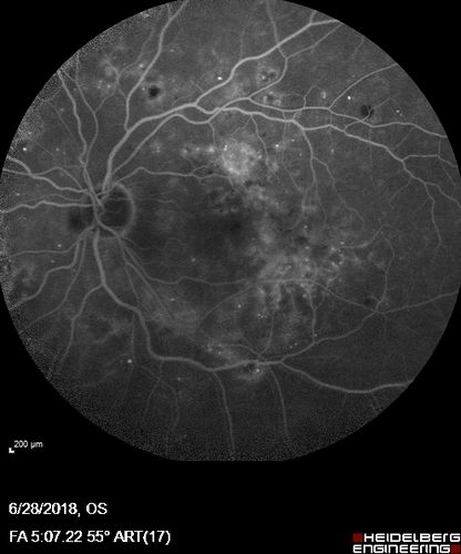 Diabetic Macular Edema with Exudates
Patient did not want injection therapy and did well with laser
