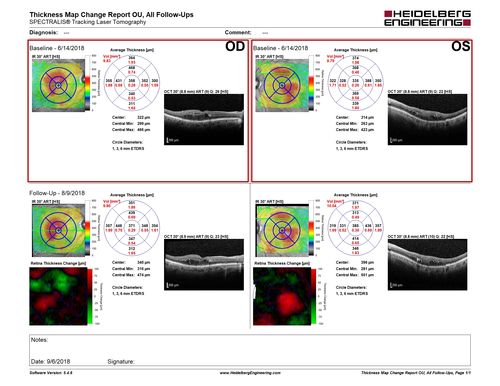 Diabetic Macular Edema with Exudates
Patient did not want injection therapy and did well with laser
