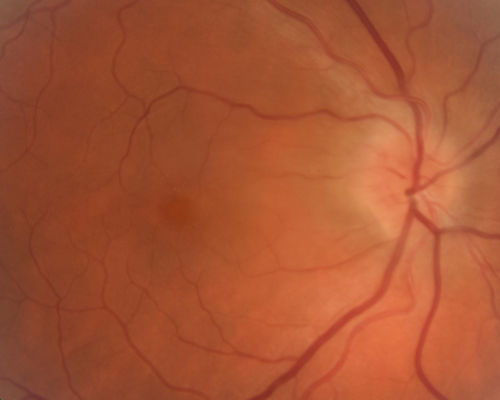 Neuroretinitis - Negative cat scratch serology twice - Possible Behcets
65 year old man with no direct cat exposure and vision loss from neuroretinitis.  His work up was positive for HLA B51.  He had negative cat scratch titers twice.  Vision dropped from 20/60 - 20/200 and then improved to 20/40 over 2 months
