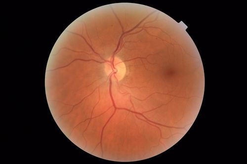 Neuroretinitis - Negative cat scratch serology twice - Possible Behcets
65 year old man with no direct cat exposure and vision loss from neuroretinitis.  His work up was positive for HLA B51.  He had negative cat scratch titers twice.  Vision dropped from 20/60 - 20/200 and then improved to 20/40 over 2 months
