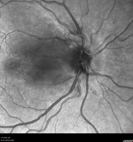 Neuroretinitis - Negative cat scratch serology twice - Possible Behcets
65 year old man with no direct cat exposure and vision loss from neuroretinitis.  His work up was positive for HLA B51.  He had negative cat scratch titers twice.  Vision dropped from 20/60 - 20/200 and then improved to 20/40 over 2 months
