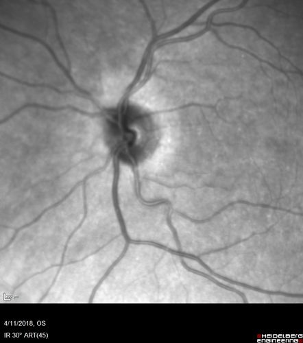 Neuroretinitis - Negative cat scratch serology twice - Possible Behcets
65 year old man with no direct cat exposure and vision loss from neuroretinitis.  His work up was positive for HLA B51.  He had negative cat scratch titers twice.  Vision dropped from 20/60 - 20/200 and then improved to 20/40 over 2 months
