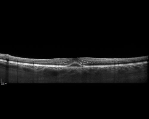 Neuroretinitis - Negative cat scratch serology twice - Possible Behcets
65 year old man with no direct cat exposure and vision loss from neuroretinitis.  His work up was positive for HLA B51.  He had negative cat scratch titers twice.  Vision dropped from 20/60 - 20/200 and then improved to 20/40 over 2 months
