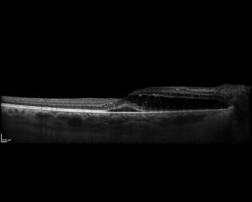 Neuroretinitis - Negative cat scratch serology twice - Possible Behcets
65 year old man with no direct cat exposure and vision loss from neuroretinitis.  His work up was positive for HLA B51.  He had negative cat scratch titers twice.  Vision dropped from 20/60 - 20/200 and then improved to 20/40 over 2 months
