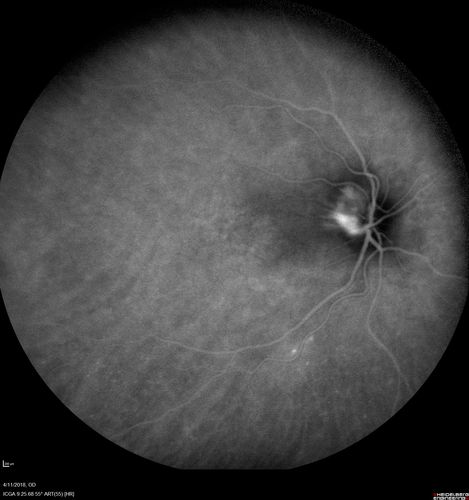 Neuroretinitis - Negative cat scratch serology twice - Possible Behcets
65 year old man with no direct cat exposure and vision loss from neuroretinitis.  His work up was positive for HLA B51.  He had negative cat scratch titers twice.  Vision dropped from 20/60 - 20/200 and then improved to 20/40 over 2 months
