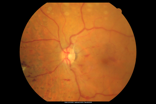 Proliferative Diabetic Retinopathy - Fresh and Old Scatter (Panretinal) Photocoagulation (Laser) - Neovascularization is regressing
1 month after initial laser
