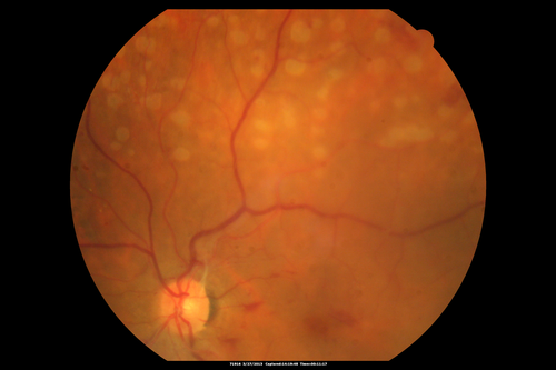 Proliferative Diabetic Retinopathy - Fresh and Old Scatter (Panretinal) Photocoagulation (Laser) - Neovascularization is regressing
1 month after initial laser
