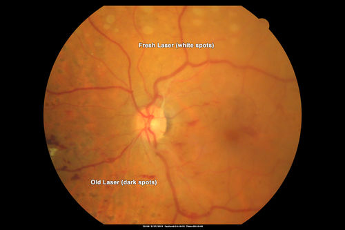 Proliferative Diabetic Retinopathy - Fresh and Old Scatter (Panretinal) Photocoagulation (Laser) - Neovascularization is regressing
1 month after initial laser

