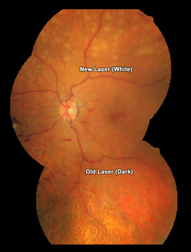 Proliferative Diabetic Retinopathy - Fresh and Old Scatter (Panretinal) Photocoagulation (Laser) - Neovascularization is regressing
1 month after initial laser
