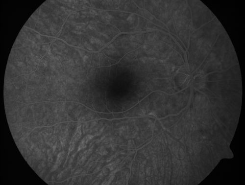 Occult Maculopathy - Thin Fovea on OCT and Normal Color VA, Photos, FA VA 20/80 OU
45-year-old man his mother and his maternal grandmother each had vision loss at a relatively young age.  Normal FA.
Keywords: occult maculopathy;foveal atrophy