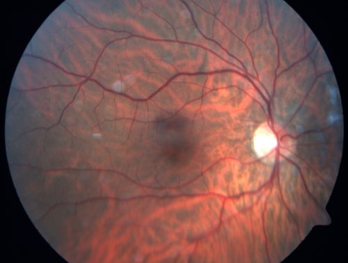 Occult Maculopathy - Thin Fovea on OCT and Normal Color VA, Photos, FA VA 20/80 OU
45-year-old man his mother and his maternal grandmother each had vision loss at a relatively young age.  Retina OD
Keywords: occult maculopathy;foveal atrophy