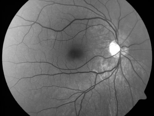 Occult Maculopathy - Thin Fovea on OCT and Normal Color VA, Photos, FA VA 20/80 OU
45-year-old man his mother and his maternal grandmother each had vision loss at a relatively young age.  Red Free Photo
Mots-clés: occult maculopathy;foveal atrophy