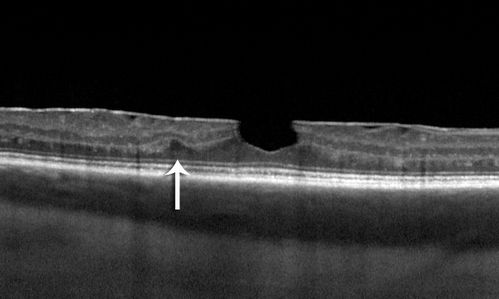 Birdshot Chorioretintis and PAMM
Patient presented with paracentral acute middle maculopathy as the presenting symptom of birdshot.  This case was published. RETINAL CASES & BRIEF REPORTS 10:151â€“153, 2016.
