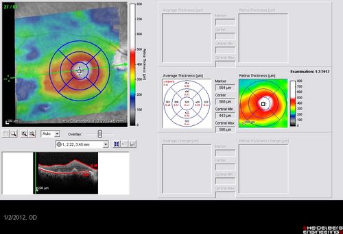Post-Retinal Detachment Repair Occult Subfoveal CNVM
This pleasant 56-year-old man has had a complex retinal detachment repair in the right eye.  I most recently removed his silicone oil 3 months ago.  His vision now is the best it has ever been. 
VISUAL ACUITY:  OD 4/200
