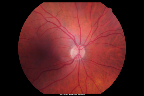 Ocular Ishemic Syndrome - Bilateral Carotid Occlusions - OD 20/60 OS 20/200 Enlarged Foveal Avascular Zone and Temporal Non-perfusion
75-year-old man had laryngeal cancer treated in 15 year ago with radiation.  He recently was told that the carotid circulation is closed off on both sides.  He does have a patent vertebral artery, which is supplying him pretty well and in addition to that his cardiac output is compromised by poor mitral valves.  His consideration is to what can be done about that in the future.  
VISUAL ACUITY:  OD 20/60,  OS 20/200
