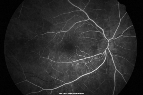 Ocular Ishemic Syndrome - Bilateral Carotid Occlusions - OD 20/60 OS 20/200 Enlarged Foveal Avascular Zone and Temporal Non-perfusion
75-year-old man had laryngeal cancer treated in 15 year ago with radiation.  He recently was told that the carotid circulation is closed off on both sides.  He does have a patent vertebral artery, which is supplying him pretty well and in addition to that his cardiac output is compromised by poor mitral valves.  His consideration is to what can be done about that in the future.  
VISUAL ACUITY:  OD 20/60,  OS 20/200
