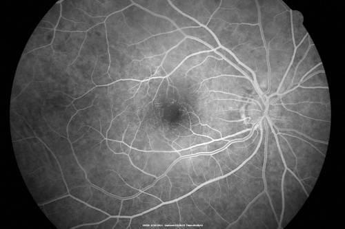 Ocular Ishemic Syndrome - Bilateral Carotid Occlusions - OD 20/60 OS 20/200 Enlarged Foveal Avascular Zone and Temporal Non-perfusion
75-year-old man had laryngeal cancer treated in 15 year ago with radiation.  He recently was told that the carotid circulation is closed off on both sides.  He does have a patent vertebral artery, which is supplying him pretty well and in addition to that his cardiac output is compromised by poor mitral valves.  His consideration is to what can be done about that in the future.  
VISUAL ACUITY:  OD 20/60,  OS 20/200
