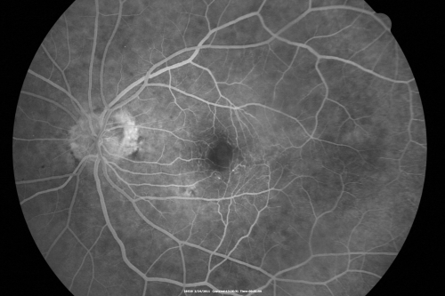 Ocular Ishemic Syndrome - Bilateral Carotid Occlusions - OD 20/60 OS 20/200 Enlarged Foveal Avascular Zone and Temporal Non-perfusion
75-year-old man had laryngeal cancer treated in 15 year ago with radiation.  He recently was told that the carotid circulation is closed off on both sides.  He does have a patent vertebral artery, which is supplying him pretty well and in addition to that his cardiac output is compromised by poor mitral valves.  His consideration is to what can be done about that in the future.  
VISUAL ACUITY:  OD 20/60,  OS 20/200
