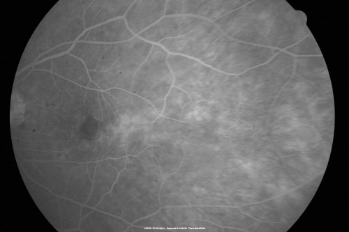 Ocular Ishemic Syndrome - Bilateral Carotid Occlusions - OD 20/60 OS 20/200 Enlarged Foveal Avascular Zone and Temporal Non-perfusion
75-year-old man had laryngeal cancer treated in 15 year ago with radiation.  He recently was told that the carotid circulation is closed off on both sides.  He does have a patent vertebral artery, which is supplying him pretty well and in addition to that his cardiac output is compromised by poor mitral valves.  His consideration is to what can be done about that in the future.  
VISUAL ACUITY:  OD 20/60,  OS 20/200
