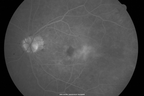 Ocular Ishemic Syndrome - Bilateral Carotid Occlusions - OD 20/60 OS 20/200 Enlarged Foveal Avascular Zone and Temporal Non-perfusion
75-year-old man had laryngeal cancer treated in 15 year ago with radiation.  He recently was told that the carotid circulation is closed off on both sides.  He does have a patent vertebral artery, which is supplying him pretty well and in addition to that his cardiac output is compromised by poor mitral valves.  His consideration is to what can be done about that in the future.  
VISUAL ACUITY:  OD 20/60,  OS 20/200
