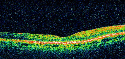Ocular Ishemic Syndrome - Bilateral Carotid Occlusions - OD 20/60 OS 20/200 Enlarged Foveal Avascular Zone and Temporal Non-perfusion
75-year-old man had laryngeal cancer treated in 15 year ago with radiation.  He recently was told that the carotid circulation is closed off on both sides.  He does have a patent vertebral artery, which is supplying him pretty well and in addition to that his cardiac output is compromised by poor mitral valves.  His consideration is to what can be done about that in the future.  
VISUAL ACUITY:  OD 20/60,  OS 20/200
