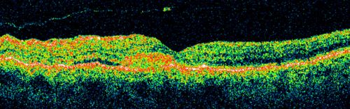 Macular Degeneration - Choroidal Laser Left eye - New Subfoveal CNVM left eye - Did well with Avastin
69-year-old woman new vision loss right eye and old macular scar left eye. OD 20/40, OS 20/200
