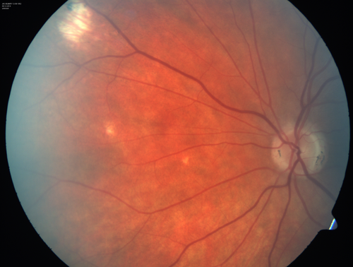 Presumed Ocular Histoplasmosis with new CNVM in right and better eye - VA 20/80 OD; 20/800 OS
Peripheral punched out small scars typical for OHS
