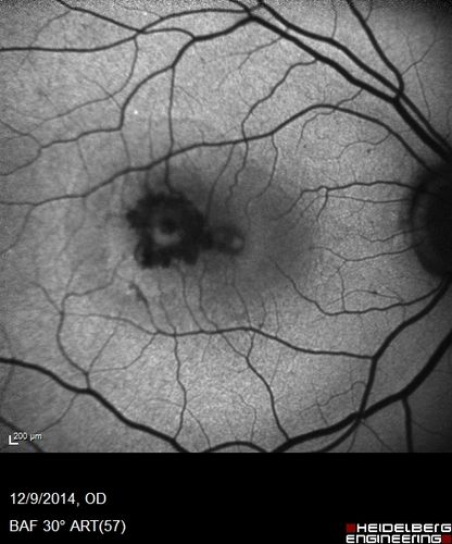 Presumed Ocular Histoplasmosis with new CNVM in right and better eye - VA 20/80 OD; 20/800 OS
Fundus Autofluorescence shows hemorrhage as dark
