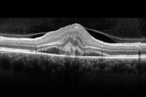 Presumed Ocular Histoplasmosis with new CNVM in right and better eye - VA 20/80 OD; 20/800 OS
