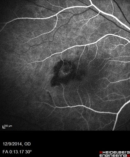 Presumed Ocular Histoplasmosis with new CNVM in right and better eye - VA 20/80 OD; 20/800 OS
Fluorescein Angiogram
