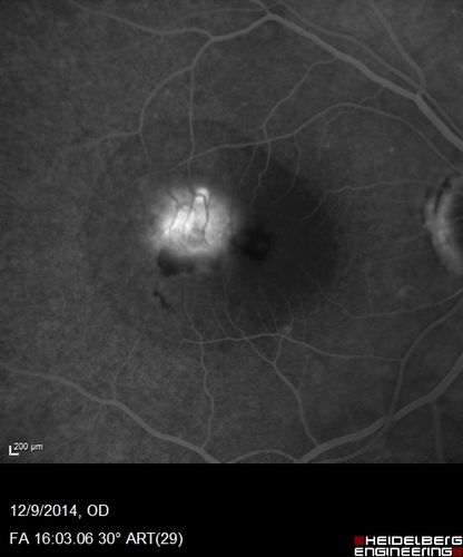 Presumed Ocular Histoplasmosis with new CNVM in right and better eye - VA 20/80 OD; 20/800 OS
Fluorescein Angiogram
