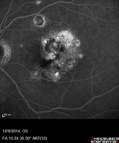 Presumed Ocular Histoplasmosis with new CNVM in right and better eye - VA 20/80 OD; 20/800 OS
Fluorescein Angiogram
