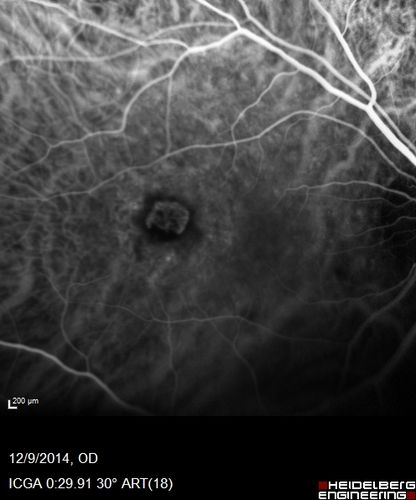Presumed Ocular Histoplasmosis with new CNVM in right and better eye - VA 20/80 OD; 20/800 OS
Indocyanine Green Angiogram
