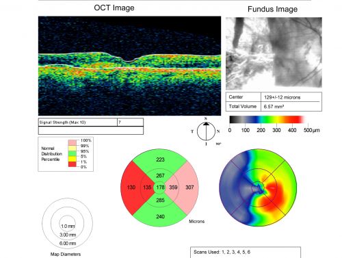 Choriodal Neovascular Membrane - Subfoveal - Pseudo-Retinitis Pigmentosa - 50 years post Retinal Detachment Repair
86-year-old with a history of decreased vision in the right eye.  The patient reports she has lost vision in the right eye over the past two months or so.  She reports the vision was always compromised in that eye since retinal detachment surgery 50 years ago with a scleral buckler. Vision dropped from 20/50 to 20/200 right eye in 2 months.

