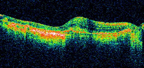 Choriodal Neovascular Membrane - Subfoveal - Pseudo-Retinitis Pigmentosa - 50 years post Retinal Detachment Repair
86-year-old with a history of decreased vision in the right eye.  The patient reports she has lost vision in the right eye over the past two months or so.  She reports the vision was always compromised in that eye since retinal detachment surgery 50 years ago with a scleral buckler. Vision dropped from 20/50 to 20/200 right eye in 2 months.

