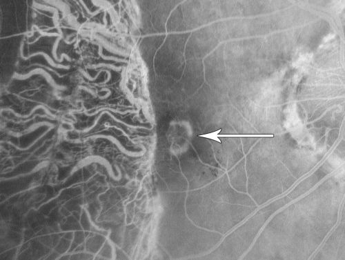Choriodal Neovascular Membrane - Subfoveal - Pseudo-Retinitis Pigmentosa - 50 years post Retinal Detachment Repair
86-year-old with a history of decreased vision in the right eye.  The patient reports she has lost vision in the right eye over the past two months or so.  She reports the vision was always compromised in that eye since retinal detachment surgery 50 years ago with a scleral buckler. Vision dropped from 20/50 to 20/200 right eye in 2 months.

