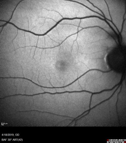Occult Macular Dystrophy - 9 Years later 
53 year old man.  Vision is better at 20/50 OU
