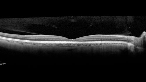 Occult Macular Dystrophy - 9 Years later 
53 year old man.  Vision is better at 20/50 OU
