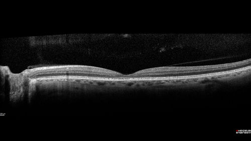 Occult Macular Dystrophy - 9 Years later 
53 year old man.  Vision is better at 20/50 OU
