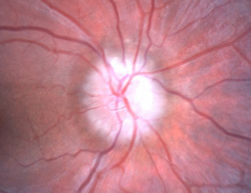 Optic Nerve Drusen in 7 Year Old Child - Miminal Calcification
7-year-old child difficulty seeing the blackboard in school.  She was checked for glasses and it was noted at that time that she had unusual looking optic nerves.  Vision OU is 20/50.  


