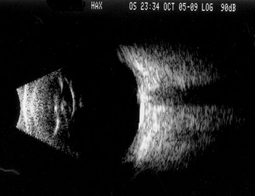 Optic Nerve Drusen in 7 Year Old Child - Miminal Calcification
7-year-old child difficulty seeing the blackboard in school.  She was checked for glasses and it was noted at that time that she had unusual looking optic nerves.  Vision OU is 20/50.  


