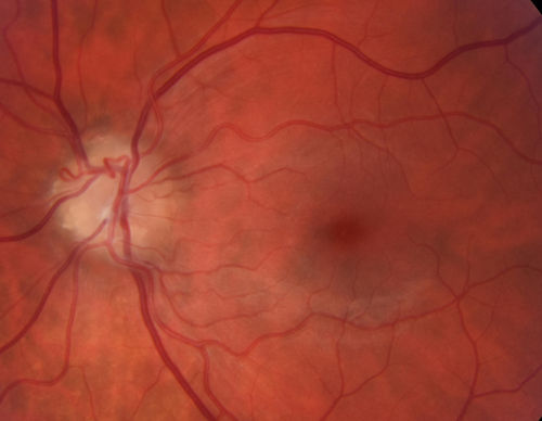 Nerve Fiber Defect from Optic Disk Drusen
31 year old male - asymptomatic
