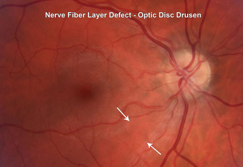 Nerve Fiber Defect from Optic Disk Drusen
31 year old male - asymptomatic
