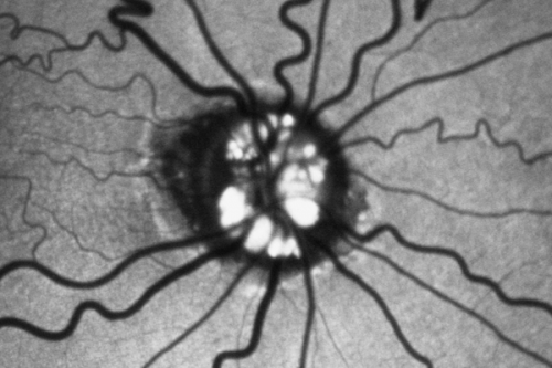 Optic Nerve Drusen - Fundus Autofluorescence - FAF
72-year-old woman  has had optic nerve drusen for sometime and has visual field abnormalities. OD 20/32,  OS 20/32. 
