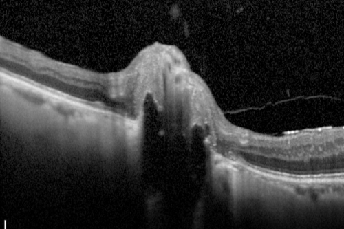 Optic Nerve Drusen -  Line Scan over Optic Nerve
72-year-old woman  has had optic nerve drusen for sometime and has visual field abnormalities. OD 20/32,  OS 20/32. 
